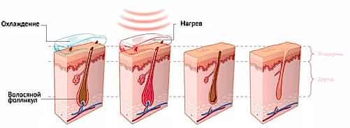 Как лазерная волна удаляет волос